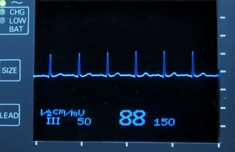A heart monitor screen showing a steady blue heartbeat trace with evenly spaced peaks and a heart rate of 88